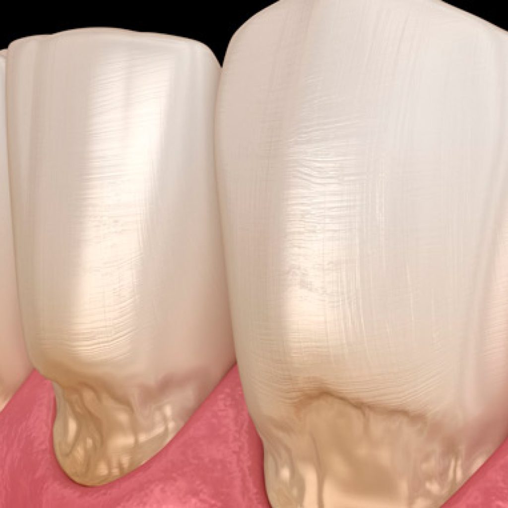 que es la abfraccion dental