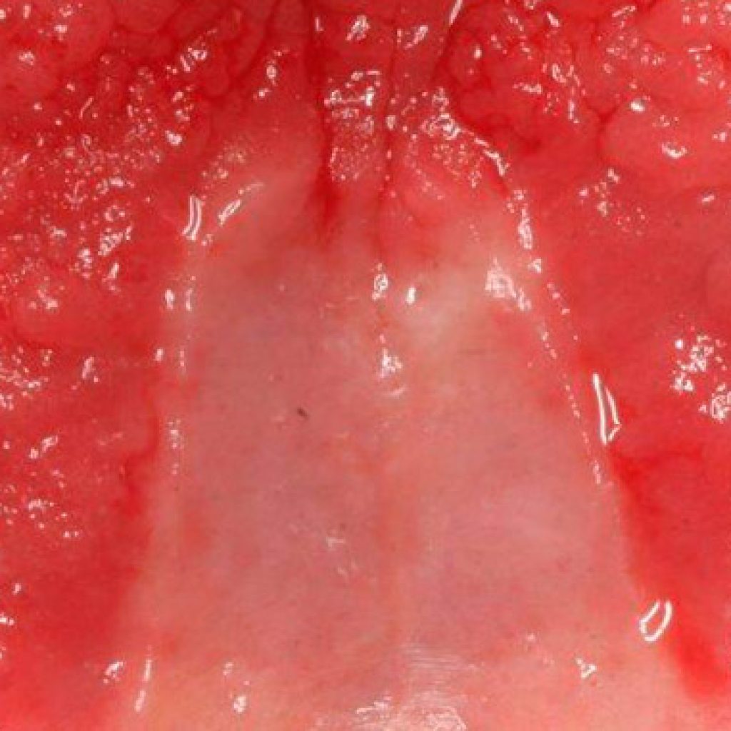 que es la candidiasis oral