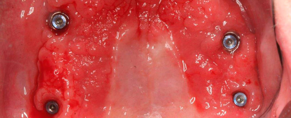 que es la candidiasis oral