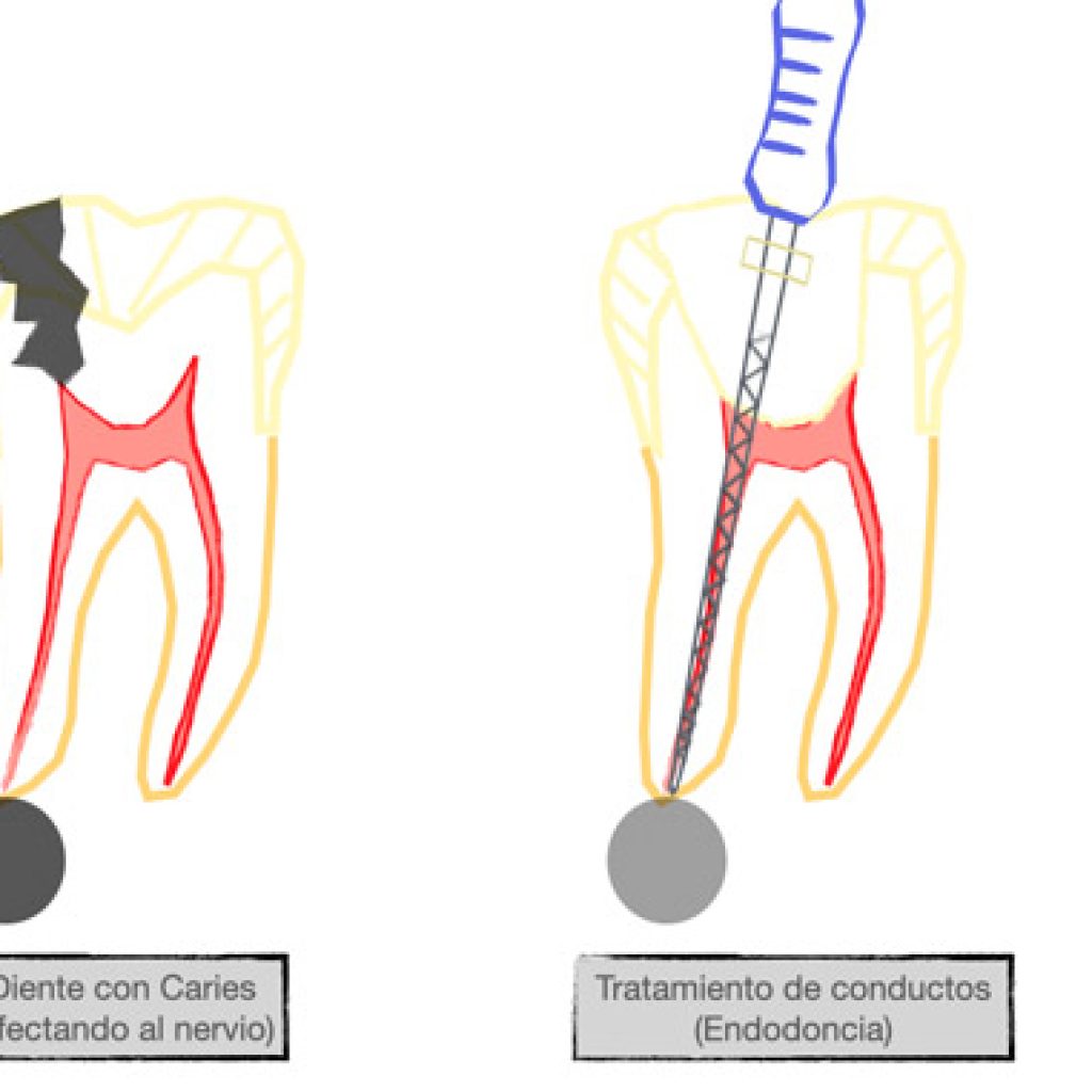 que es la endodoncia