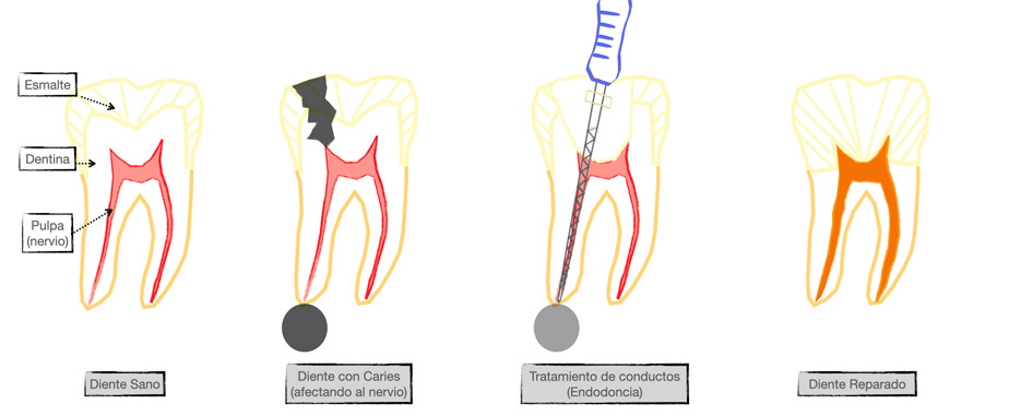 que es la endodoncia