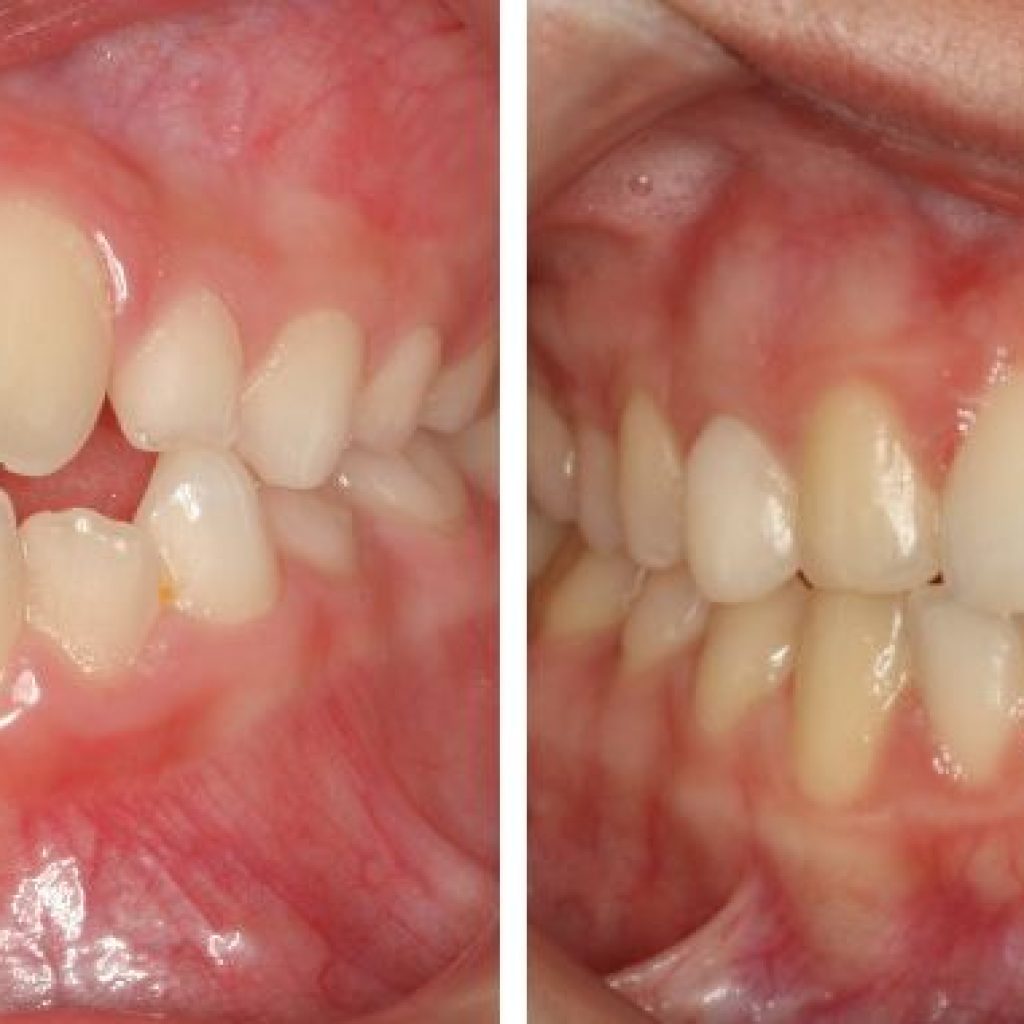 que es la mordida de tijera