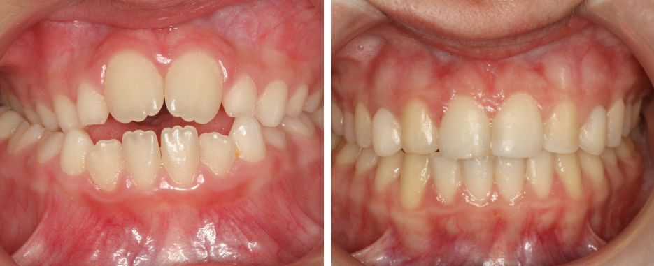 que es la mordida de tijera