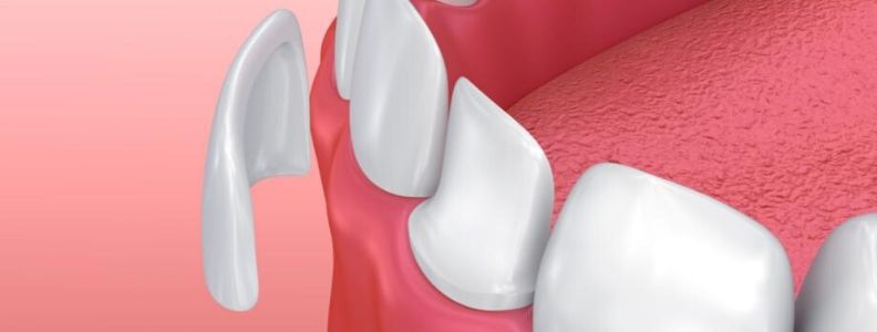 que son las carillas dentales, para que sirven y tipos