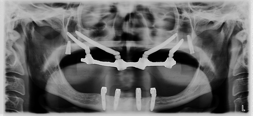radiografia de una paciente con implantes cigomaticos zygomatic implant x-ray