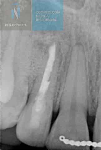 radiographic healing of apical treatment in endodontic failure idim dental implant clinic in valencia