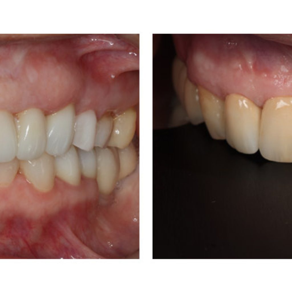 tecnica bopt despues