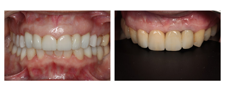 tecnica bopt despues