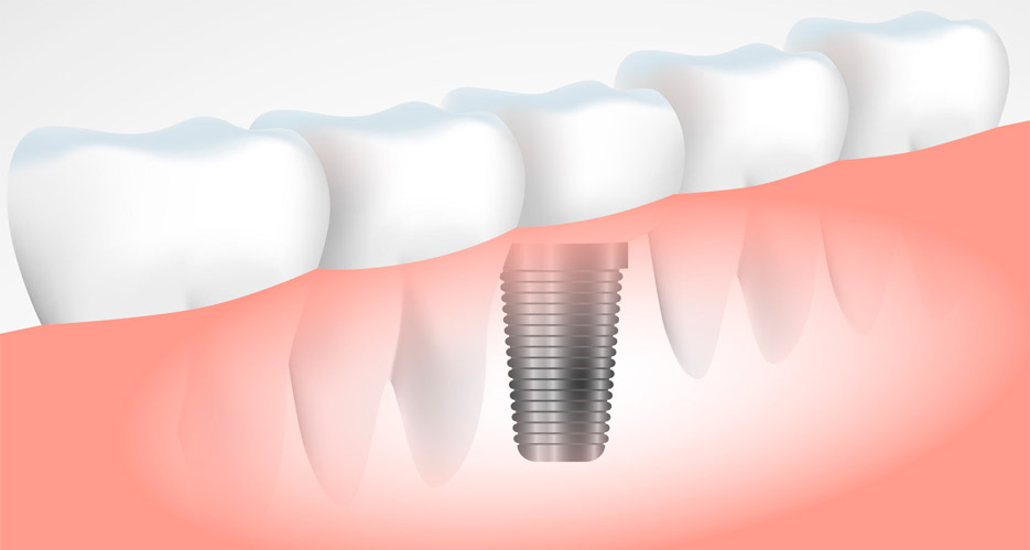 Informacion sobre laduracion del tratamiento de implantes dentales todo sobre la duracion del tratamiento de implantes dentales