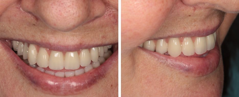 tipos de implantes dentales para pacientes con perdida osea