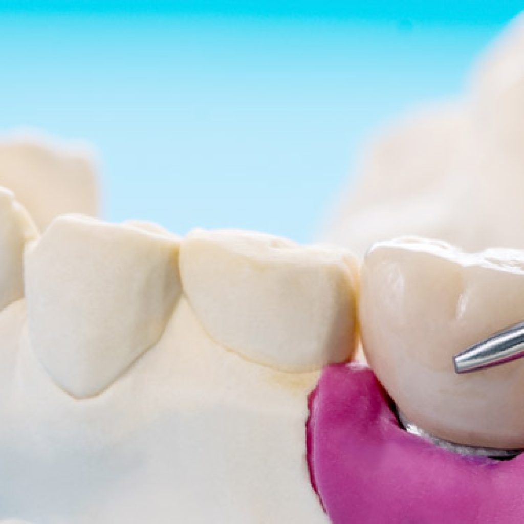 tipos de implantes y pilares implantologicos
