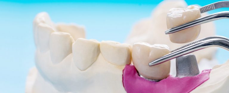 tipos de implantes y pilares implantologicos