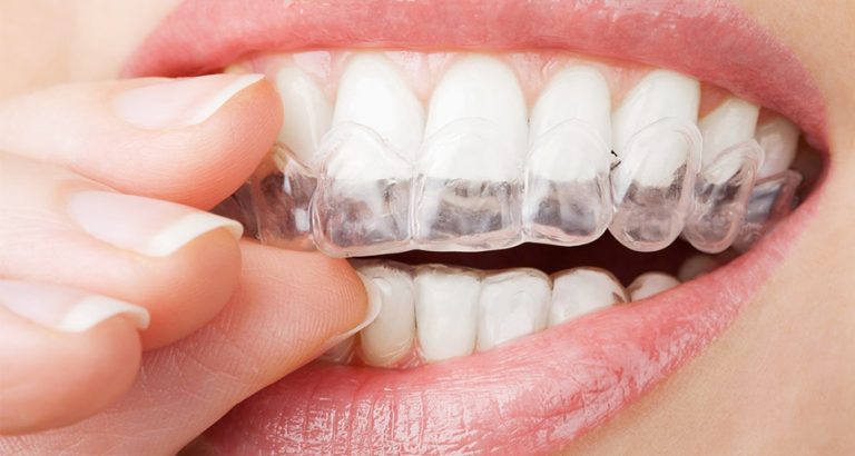 Tipos de retenedores dentales