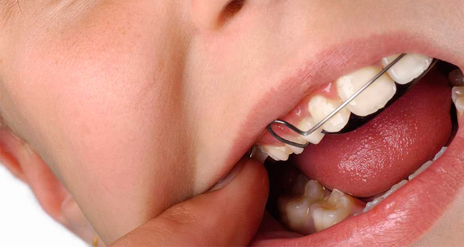 Tipos de retenedores dentales Clinica Idim