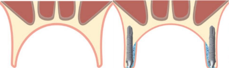 tipos implantes palatinizados