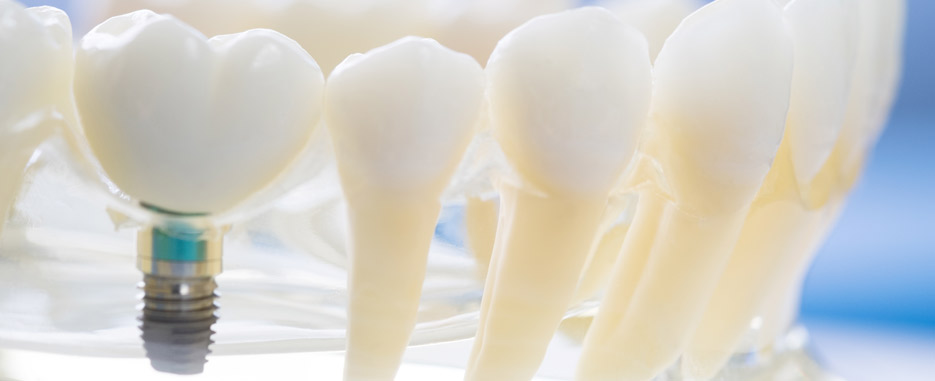 tipos implantes