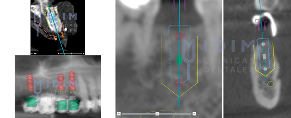 tomografias computerizadas-de-implantes dentales sin cirugia
