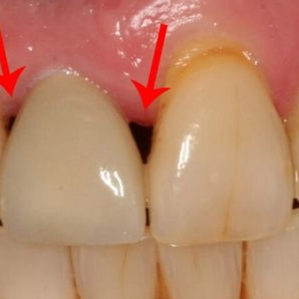 que son la troneras dentales