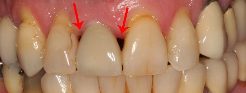 que son la troneras dentales