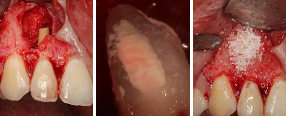 ultimo paso cirugia periapical
